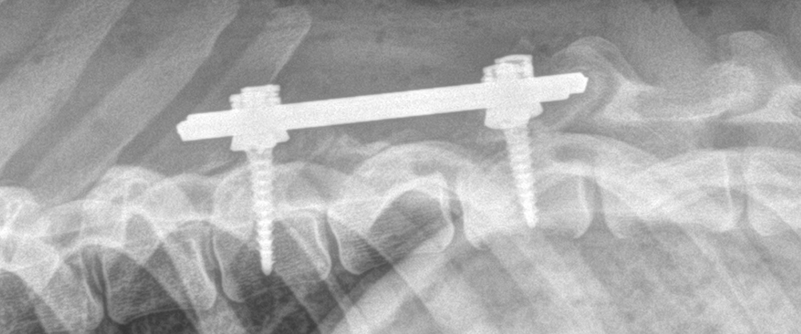 Estabilización vertebral con tornillos pediculares