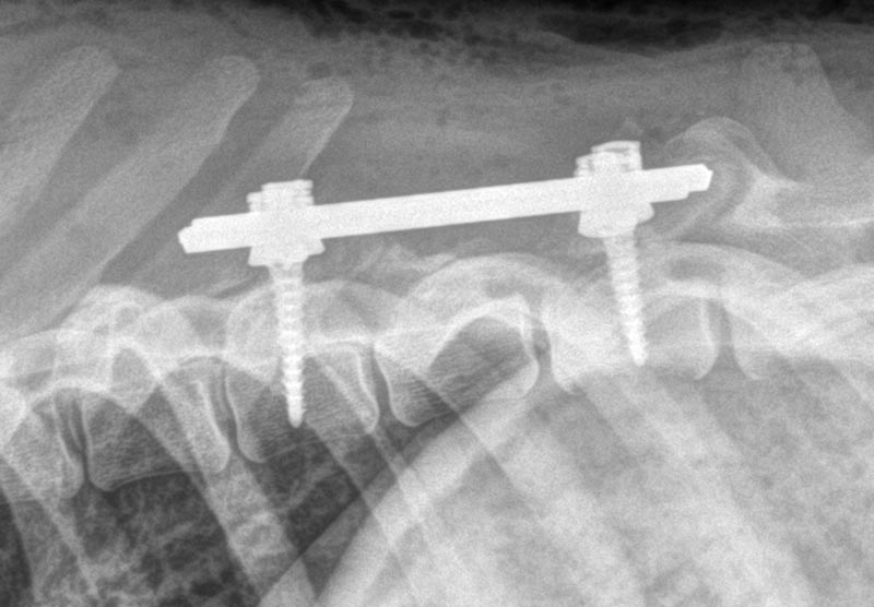 Estabilización vertebral con tornillos pediculares y planificación tomográfica