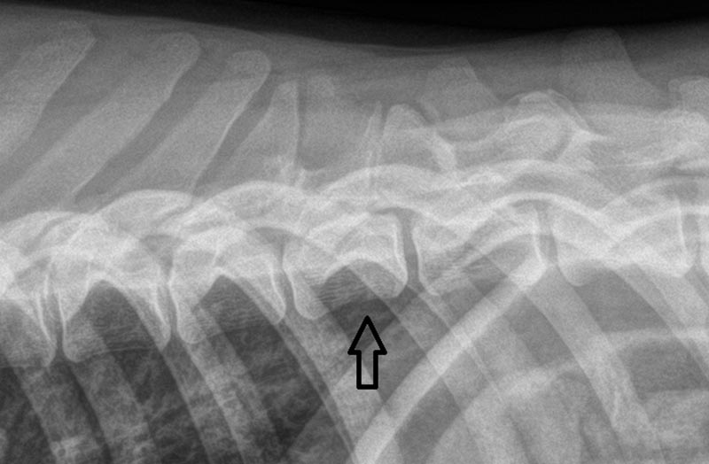 Estabilización vertebral con tornillos pediculares y planificación tomográfica