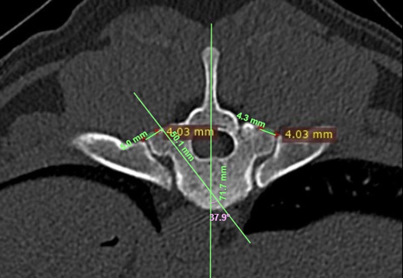 Estabilización vertebral con tornillos pediculares y planificación tomográfica