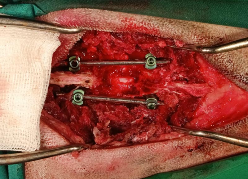 Estabilización vertebral con tornillos pediculares y planificación tomográfica