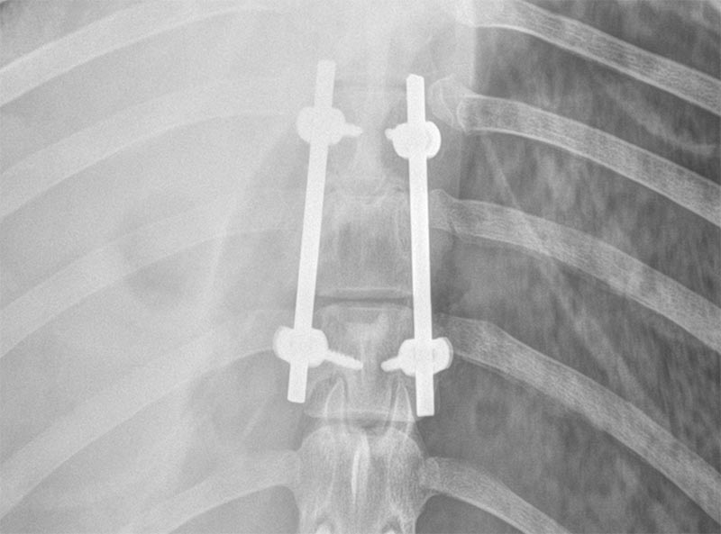 Estabilización vertebral con tornillos pediculares y planificación tomográfica