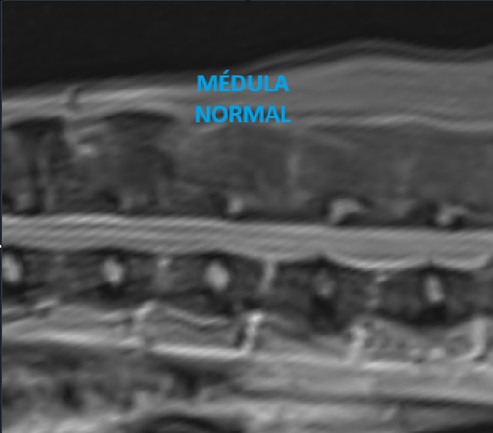 Corpectomía en perros: descompresión ventral de médula espinal