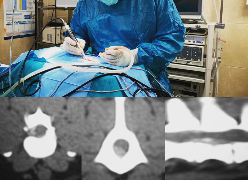 Hemilaminectomía y cirugía de tumor espinal: dos casos clínicos